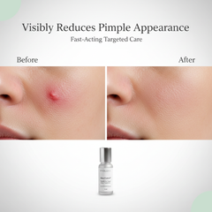 ClearFusion Powder-to-Cream Acne Treatment