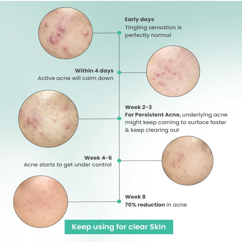 RapidClear Acne Facewash