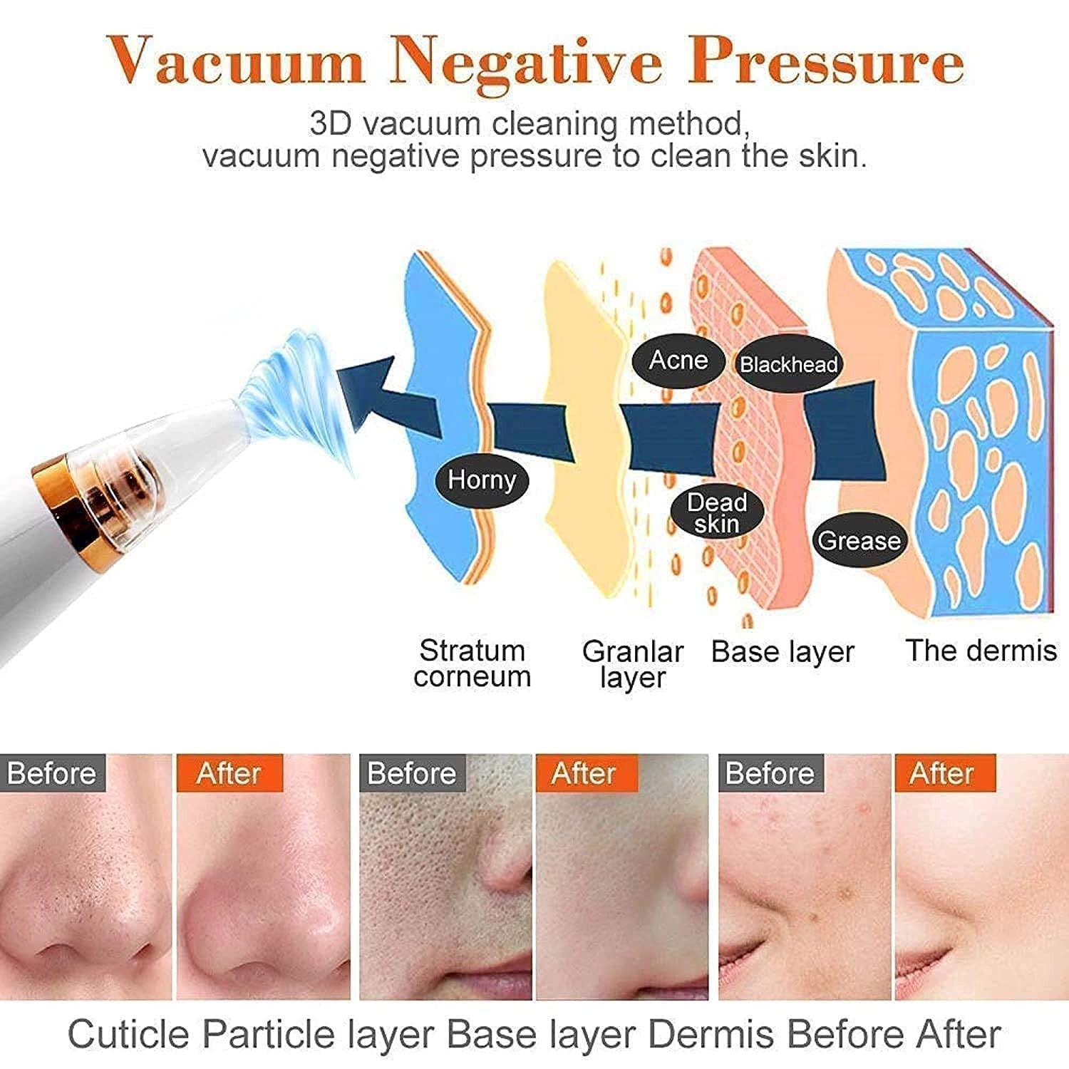PoreRefiner 6-in-1 Electric Blackhead Remover