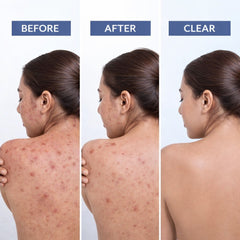BodyAcne Warrior - Acne Control Spray  For Acne on Back, Shoulders & Neck
