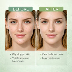 BlackheadX Volcano Clay Stick with Green Anti-Acne Clay Stick