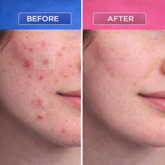 AcnePatch Roll