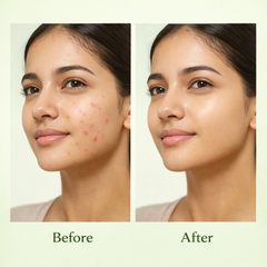 ClearBalance Acne Care Routine