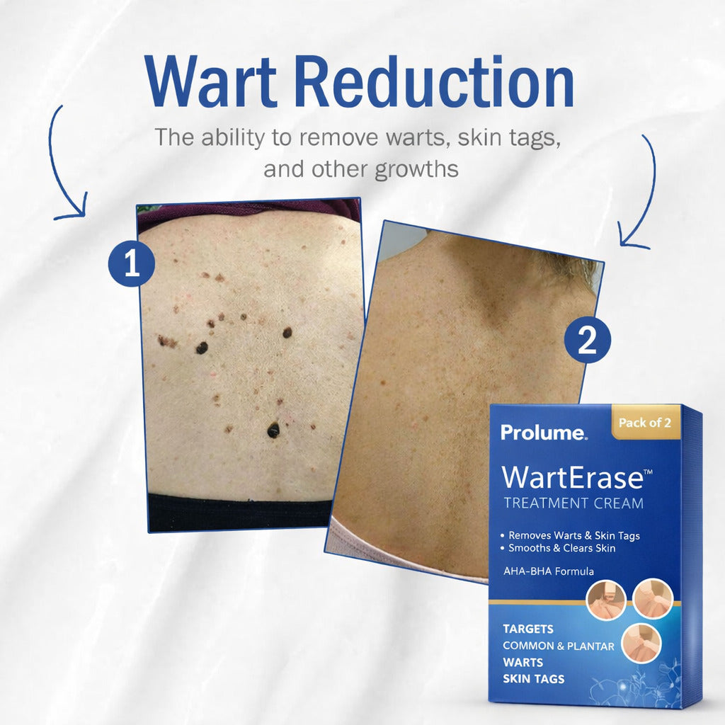 WartEraseTreatment Cream (Pack of 2)  AHA-BHA Advanced Skin Correction Formula